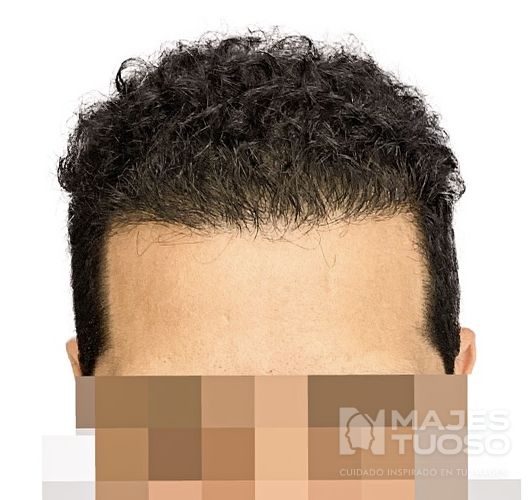 Después · Caso 1 · Línea frontal · Dr. Jhanes Calcaño