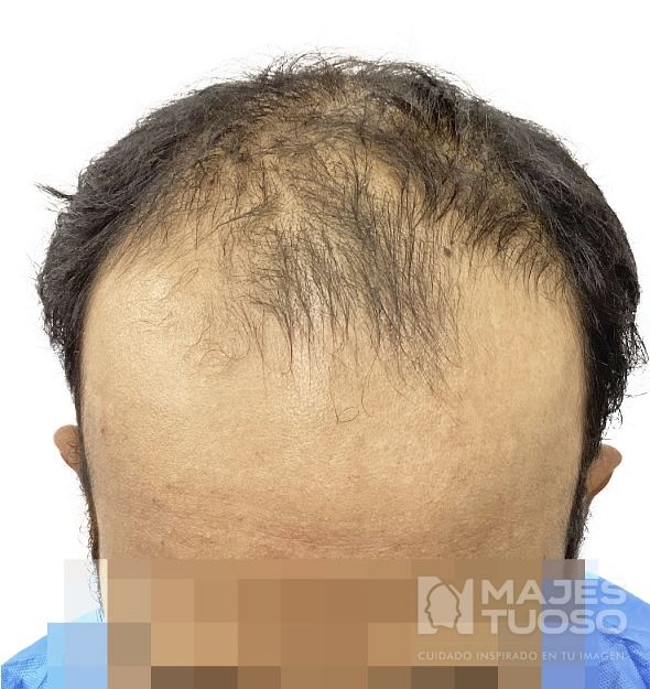 Antes · Caso 3 · Línea frontal · Dr. Jhanes Calcaño