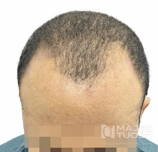 Antes · Caso 4 · Frontal y zona superior · Dr. Jhanes Calcaño