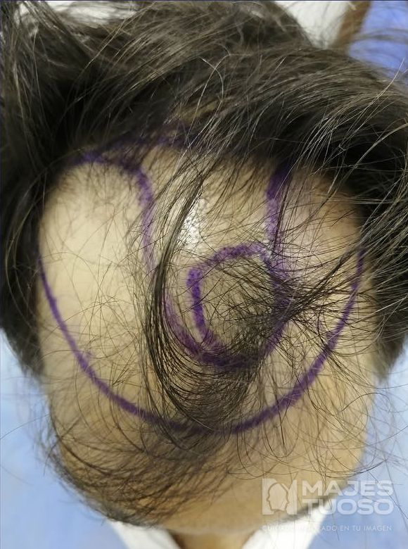 Antes · Caso 6 · Frontal y zona superior · Dr. Jhanes Calcaño