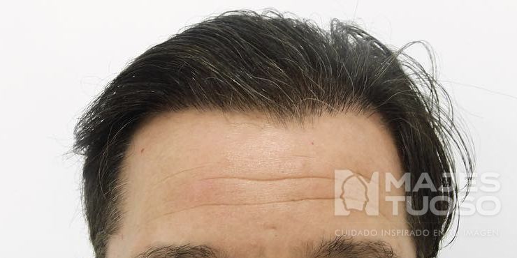 Después · Caso 8 · Línea frontal · Dr. Jhanes Calcaño