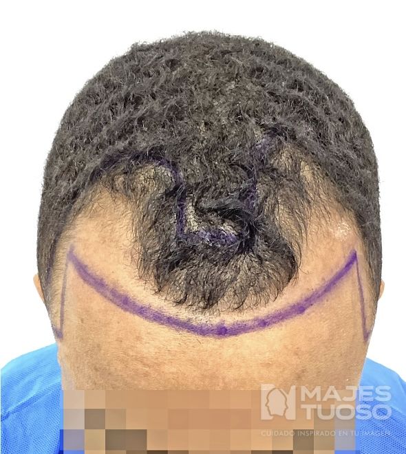 Antes · Caso 9 · Línea frontal · Dr. Jhanes Calcaño
