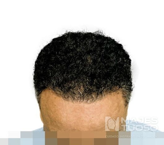 Después · Caso 11 · Línea frontal · Dr. Jhanes Calcaño