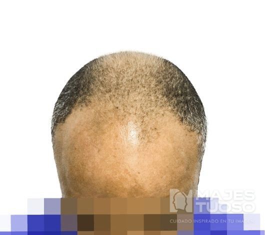 Antes · Caso 11 · Línea frontal · Dr. Jhanes Calcaño