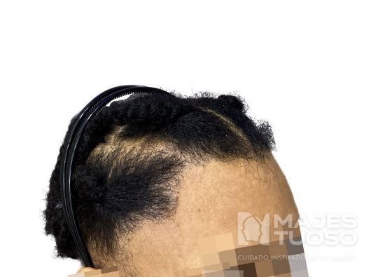 Después · Caso 12 · Línea frontal femenina · Dr. Jhanes Calcaño
